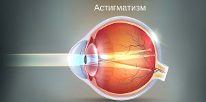 Лечение Астигматизма с помощью коррекции зрения